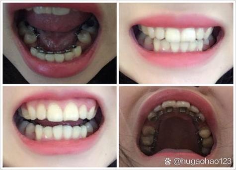 自己用舌头矫正牙齿-图3