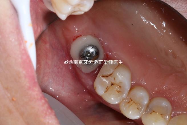牙齿矫正时种植钉发炎是什么原因?需要如何处理才能继续矫正?-图1 牙齿矫正时种植钉发炎是什么原因?需要如何处理才能继续矫正?-图1