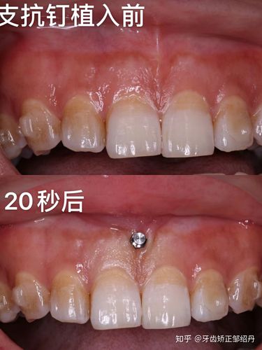 牙齿矫正时种植钉发炎是什么原因?需要如何处理才能继续矫正?-图2 牙齿矫正时种植钉发炎是什么原因?需要如何处理才能继续矫正?-图2
