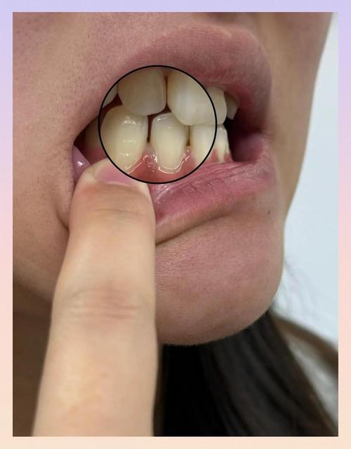 矫正牙齿牙龈萎缩图-图2