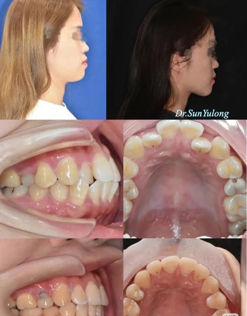 21岁拔牙矫正牙齿-图2