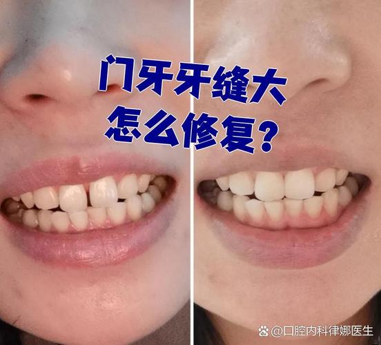 矫正后牙缝变大？是矫正失败还是正常现象？该如何应对？-图2