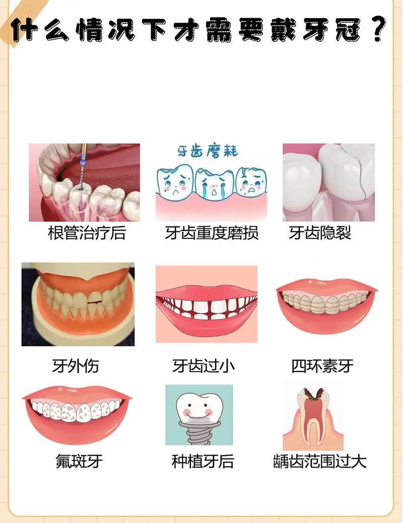 美容冠矫正牙齿的具体步骤和效果如何？-图3