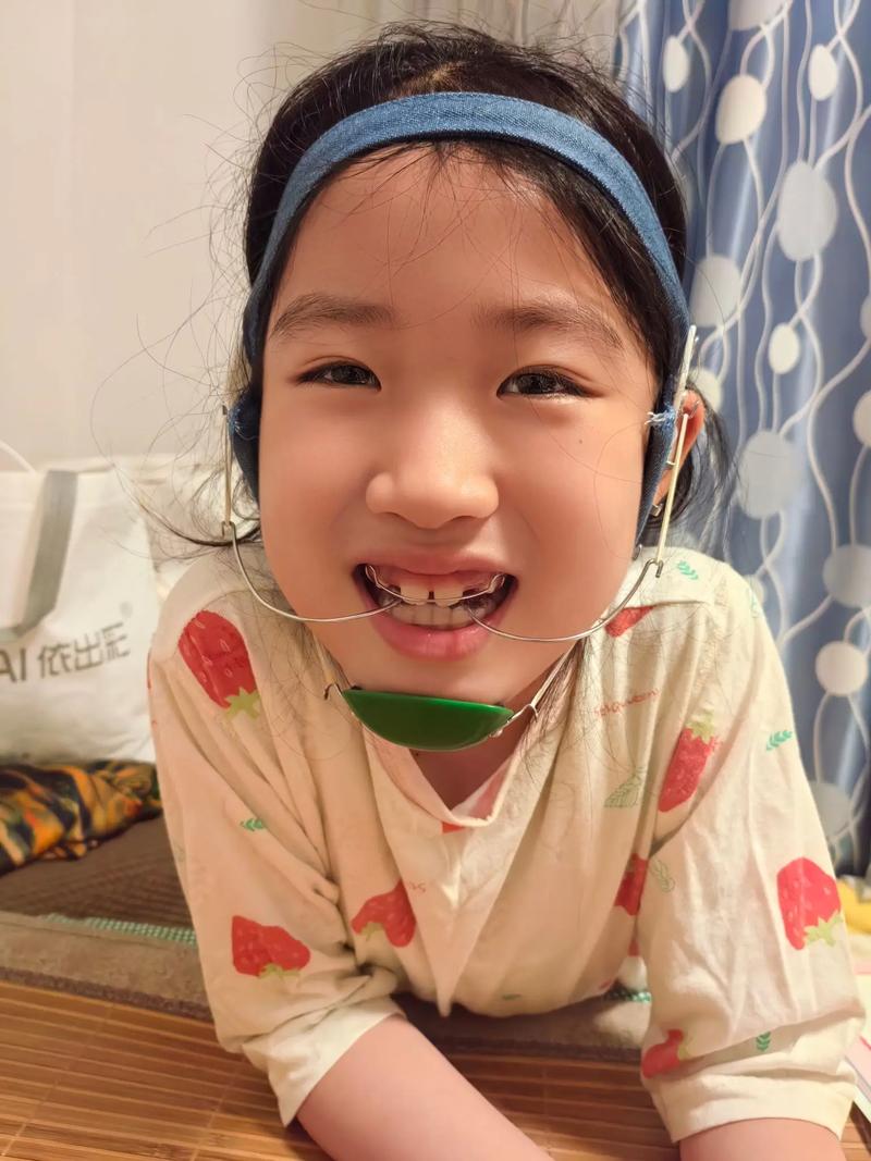 牙齿矫正头套怎么戴才对？新手必看的正确步骤-图1