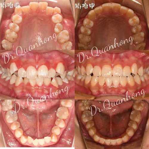 广州牙齿矫正真的会有哪些健康危害呢？-图2