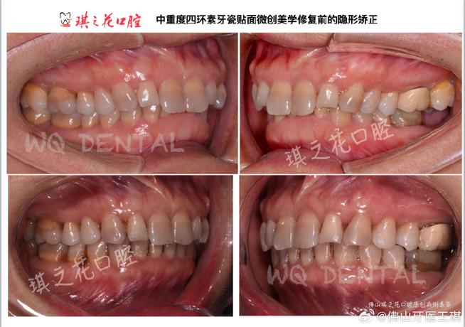 隐形矫正牙齿的坏处，真的像想象中那么少吗？-图2