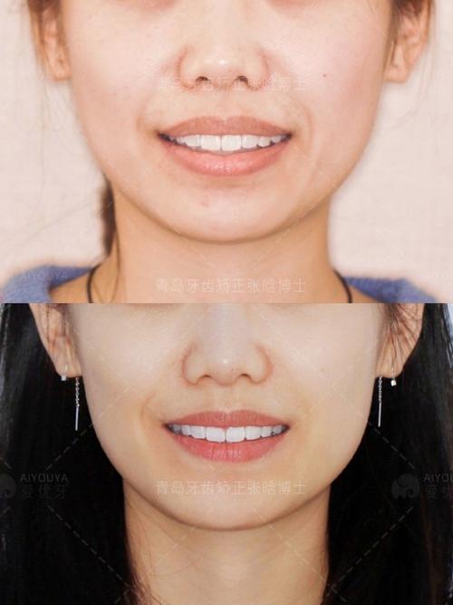 不拔牙矫正牙齿，脸型真的能改变吗？-图1