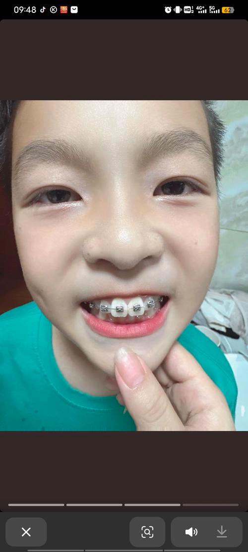 永川矫正牙齿哪里好-图1 永川矫正牙齿哪里好-图1