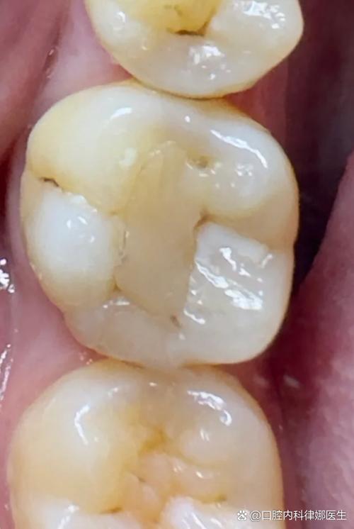 矫正牙齿为何会导致牙神经坏死？-图3