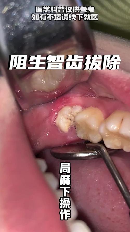 矫正牙齿期间长智齿-图2