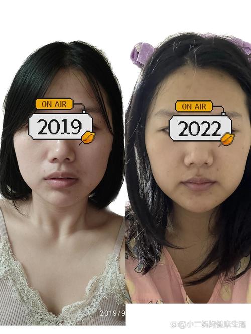 矫正牙齿拔牙脸颊凹-图1 矫正牙齿拔牙脸颊凹-图1
