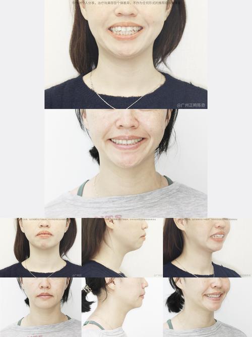 矫正牙齿拔牙脸颊凹-图3 矫正牙齿拔牙脸颊凹-图3