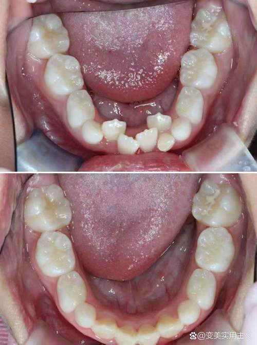 矫正后咬合不齐？原因何在或如何补救？-图1