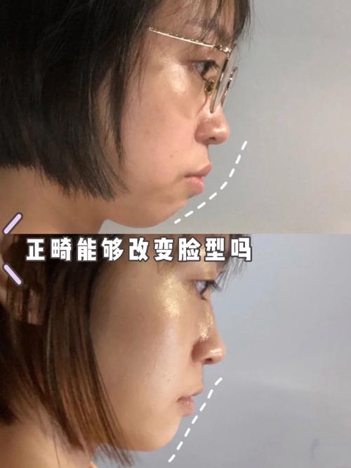 矫正牙齿后牙齿前倾-图3