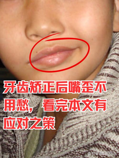 矫正牙齿导致脸歪，是矫正出了问题吗？-图1