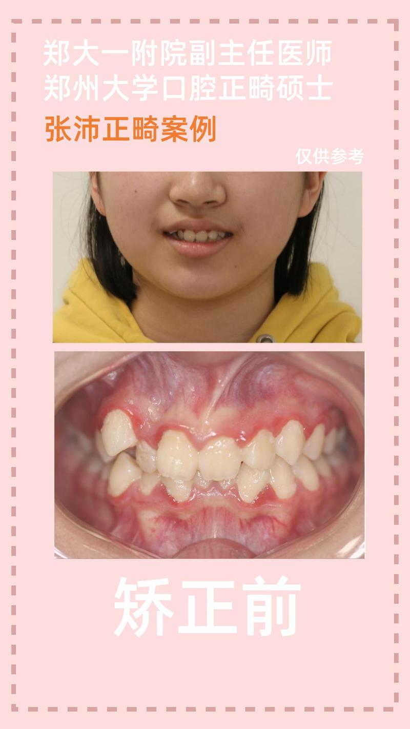 矫正后牙齿中线不齐，是什么原因导致的？该如何处理？-图3
