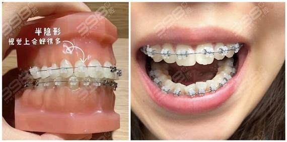 陶瓷半隐形矫正牙齿，半隐形效果如何？-图3