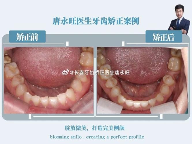 长春牙齿矫正哪里好-图3