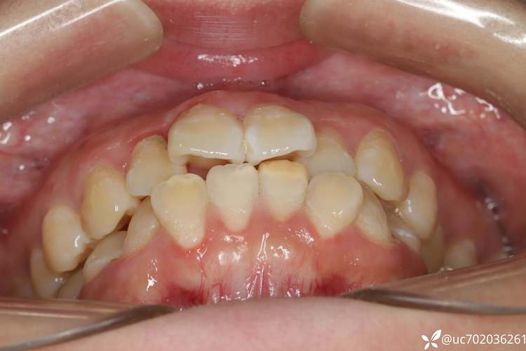 22岁牙齿矫正拔牙是必须的吗？拔牙风险和效果如何？-图2