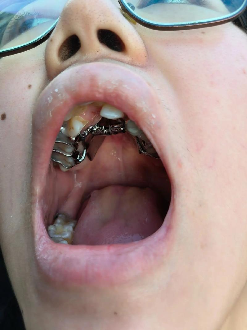 22岁牙齿矫正拔牙是必须的吗？拔牙风险和效果如何？-图3