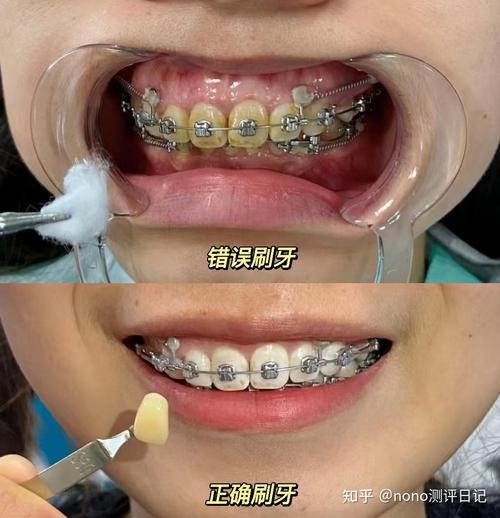 丽水矫正牙齿哪里好-图2 丽水矫正牙齿哪里好-图2