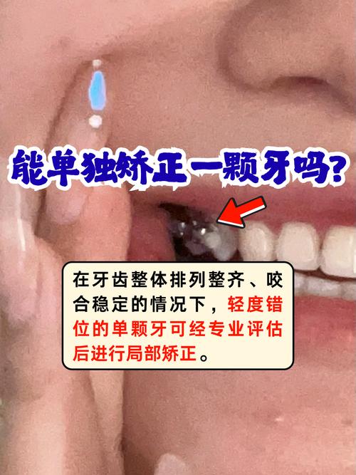 牙齿可以单个矫正吗?单个矫正可行吗?-图2 牙齿可以单个矫正吗?单个矫正可行吗?-图2