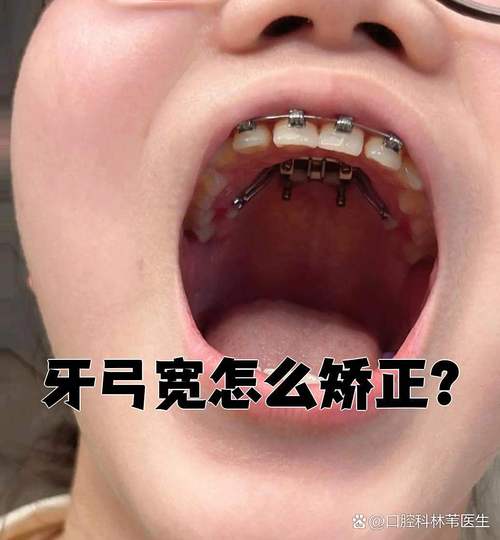 矫正牙齿不戴牙套可行吗？有哪些替代矫正方式？-图2