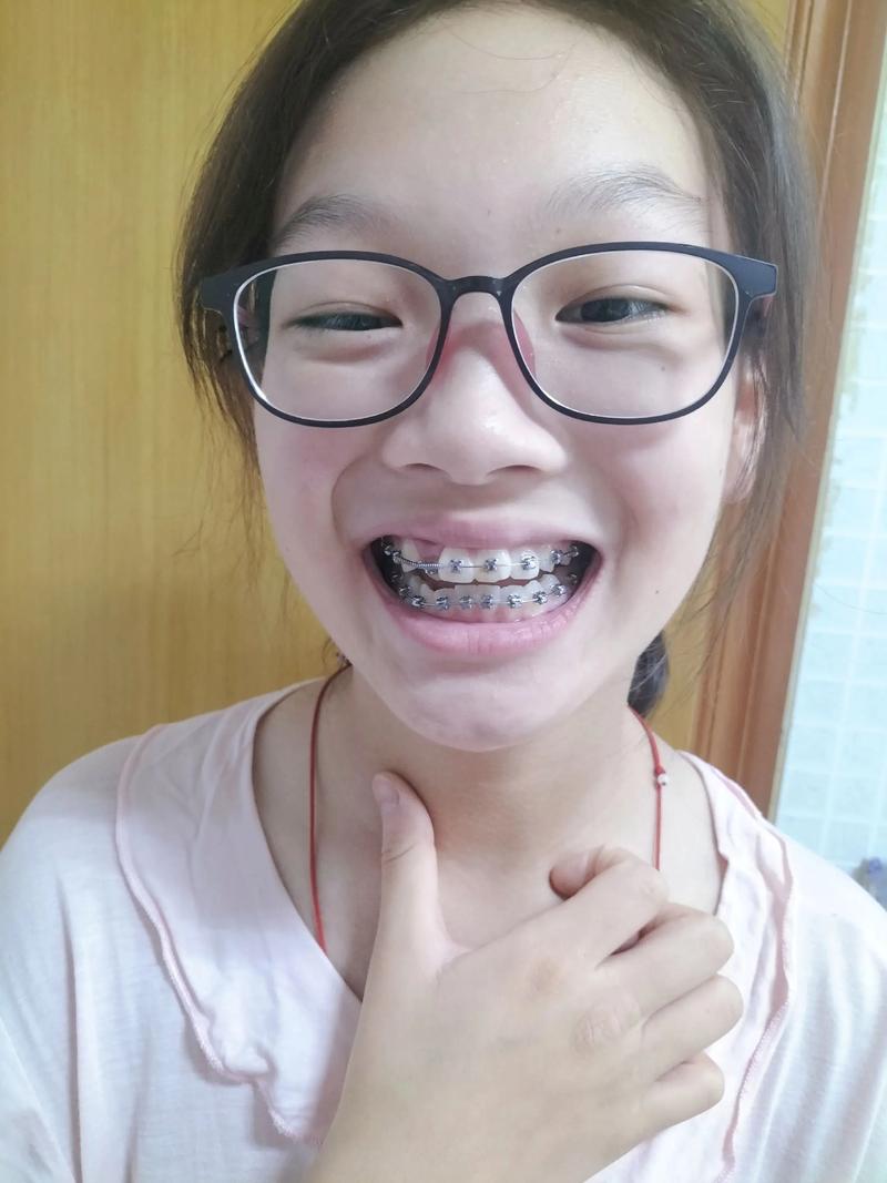 绍兴牙齿矫正去哪好？专业机构怎么选？-图2