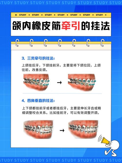 牙齿矫正橡皮链的作用到底是什么?-图1 牙齿矫正橡皮链的作用到底是什么?-图1