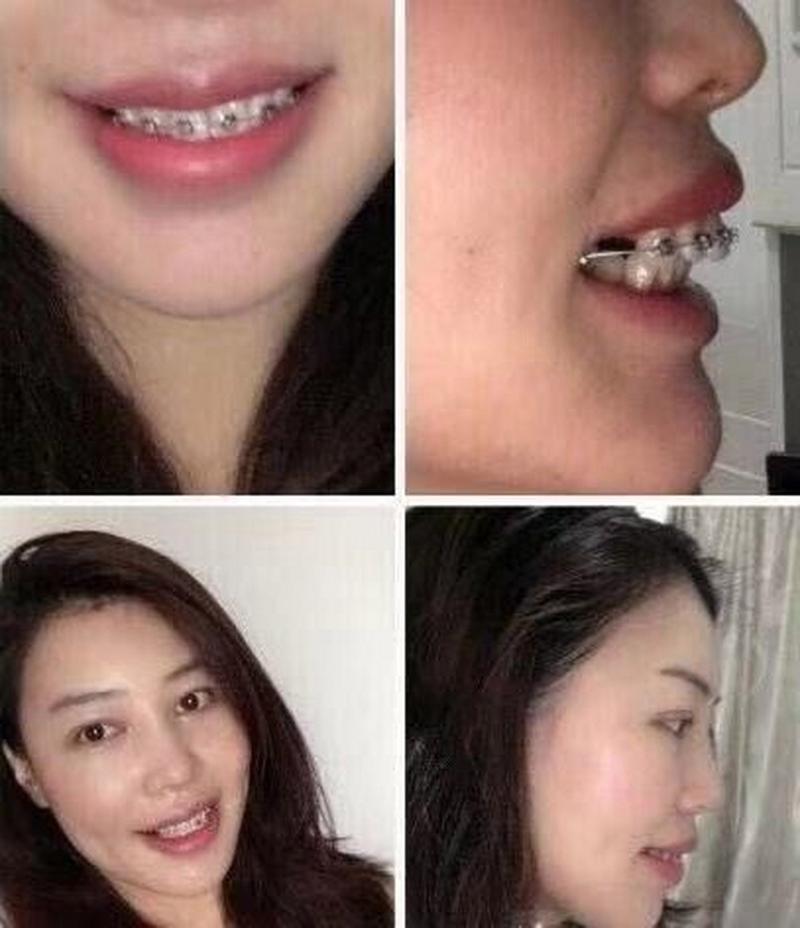 22岁龅牙矫正可行吗？效果与注意事项有哪些？-图2