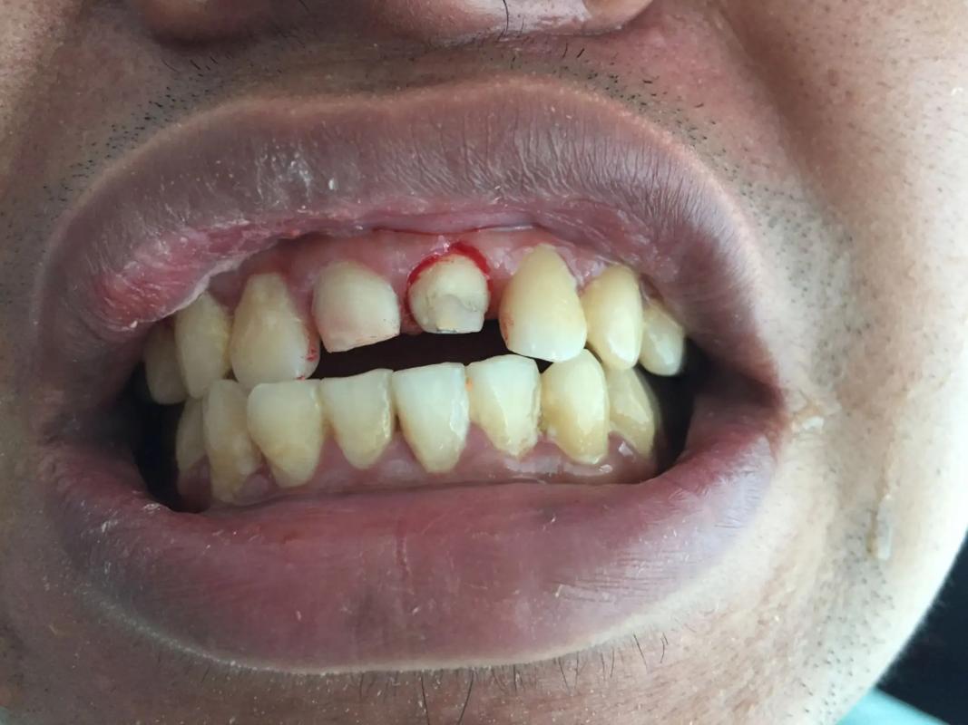 牙齿矫正还是美容冠-图3