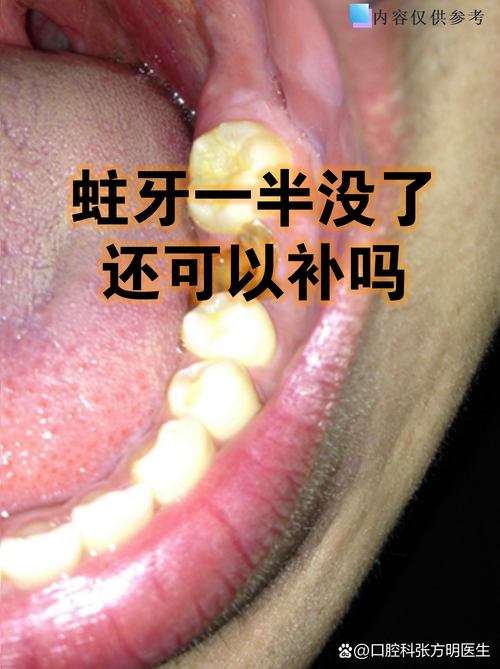 蛀牙多，还能矫正牙齿吗？-图2