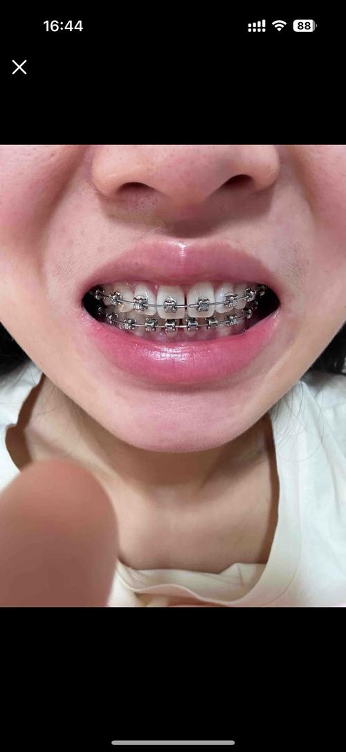 牙齿矫正后为何有牙缝？原因分析与应对方法-图3