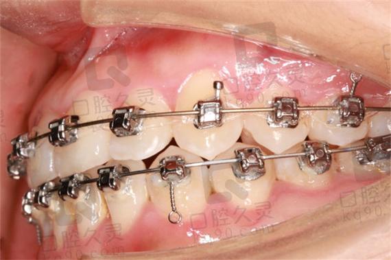 东莞矫正牙齿哪家好？求靠谱推荐！-图2