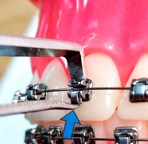 矫正牙齿托槽的位置为何对矫正效果至关重要？-图1