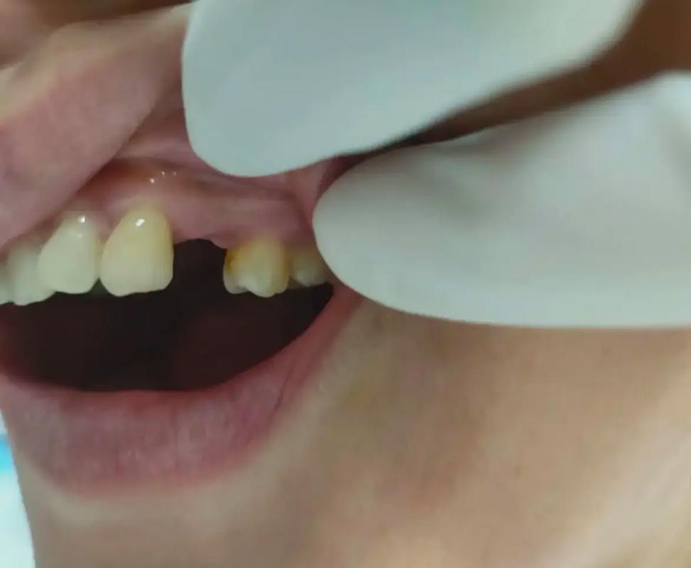 缺一颗牙能做牙齿矫正吗？效果会受影响吗？-图1