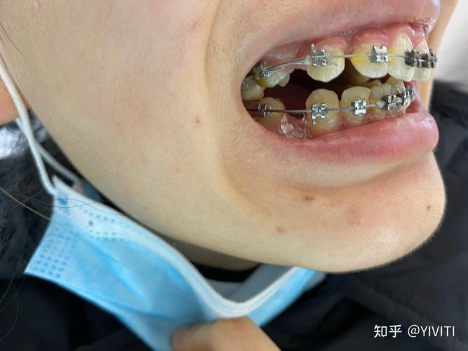 上海矫正牙齿效果如何？体验好不好？-图3