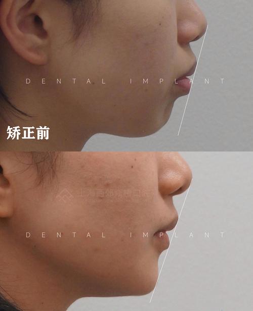 矫正牙齿改变脸型?效果如何?是真的吗?-图3 矫正牙齿改变脸型?效果如何?是真的吗?-图3
