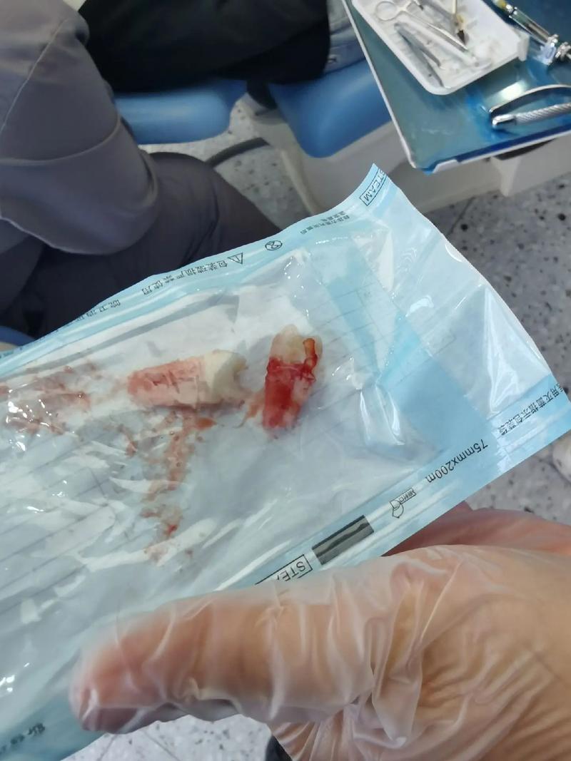 牙齿矫正拔虎牙?原因和后续影响有哪些?-图3 牙齿矫正拔虎牙?原因和后续影响有哪些?-图3