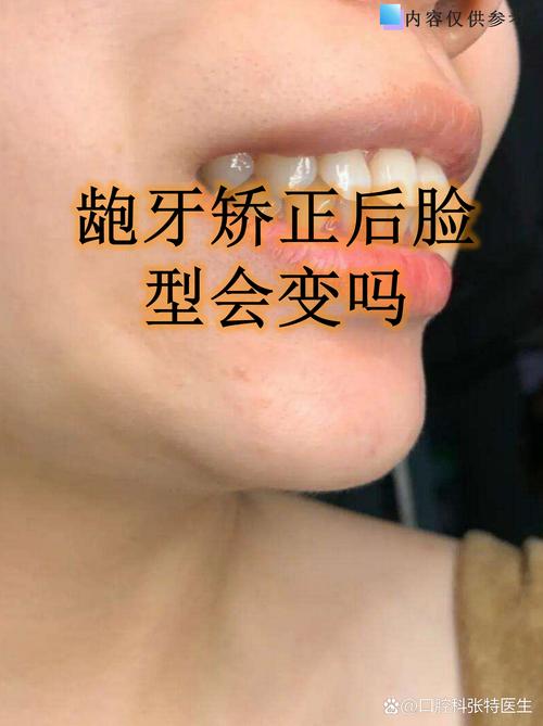 骨性龅牙矫正真的能改善吗？牙齿效果如何？-图1