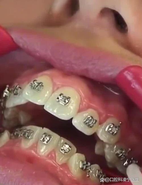 矫正完牙齿松动,是正常现象吗?该如何处理呢?-图2 矫正完牙齿松动,是正常现象吗?该如何处理呢?-图2