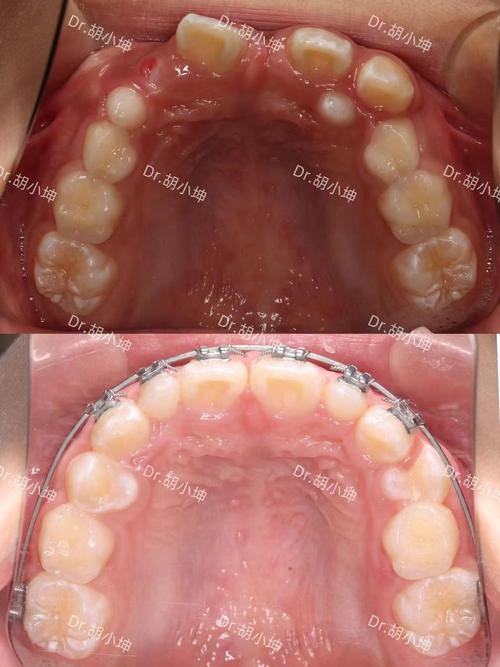 南京矫正牙齿哪家好-图2