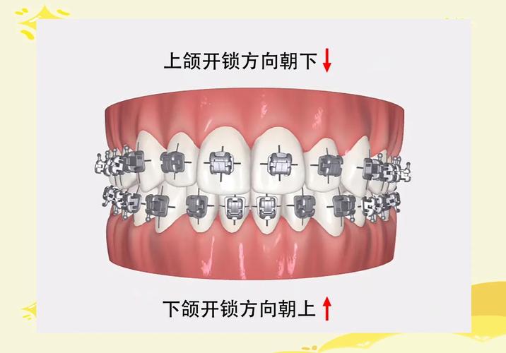 矫正牙齿中，托槽到底是什么？-图1