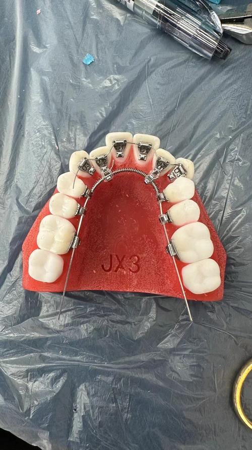 矫正牙齿中，托槽到底是什么？-图3