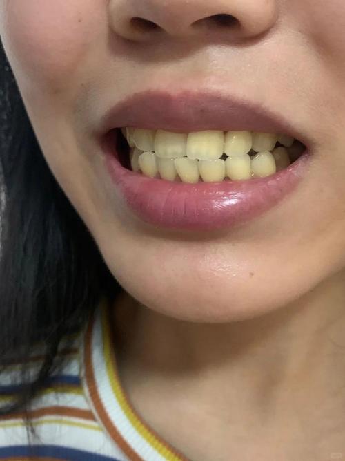 矫正后牙齿为何变黄？原因及应对方法-图2