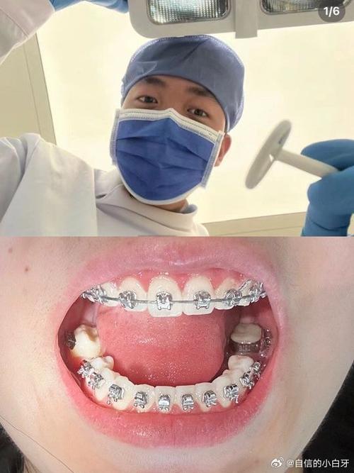 矫正后牙齿为何变黄？原因及应对方法-图1