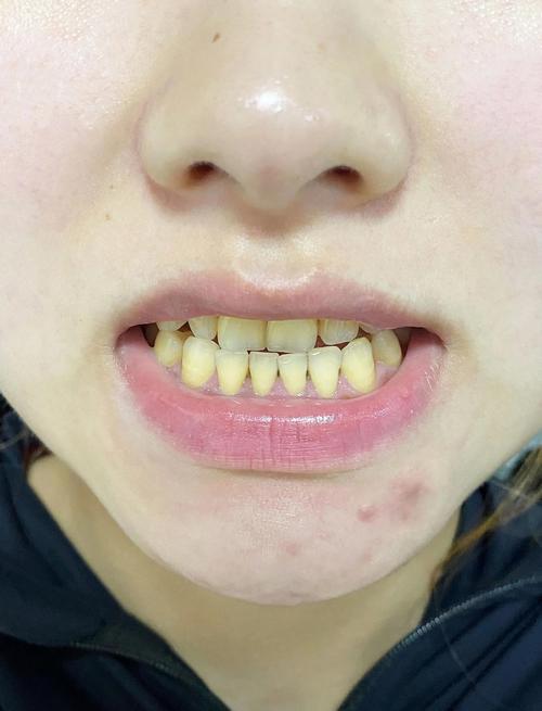 矫正后牙齿为何变黄？原因及应对方法-图3