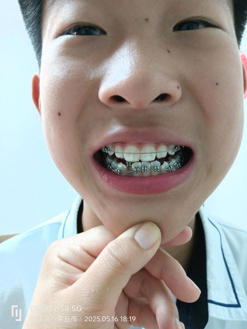 22岁矫正牙齿晚不晚？还有年龄限制吗？-图3