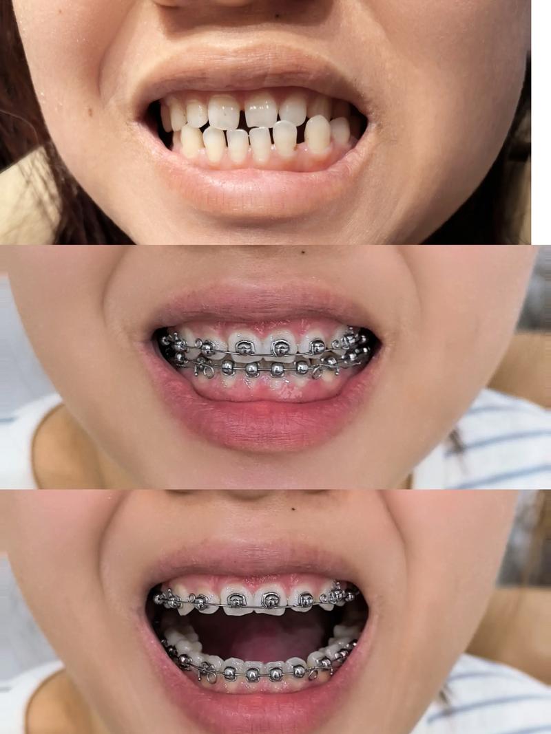 成人矫正牙齿反弹，原因究竟是什么？如何有效预防？-图3