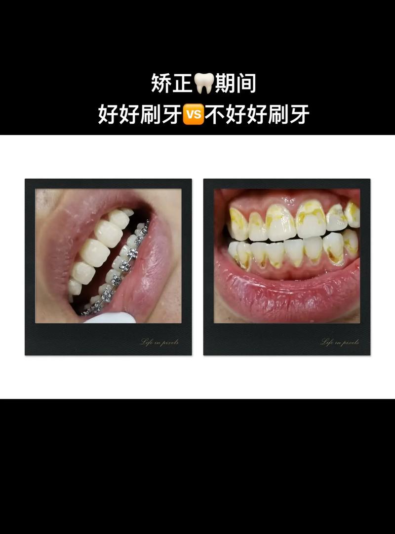 牙齿矫正会有后遗症吗？这些风险矫正前要知道-图1